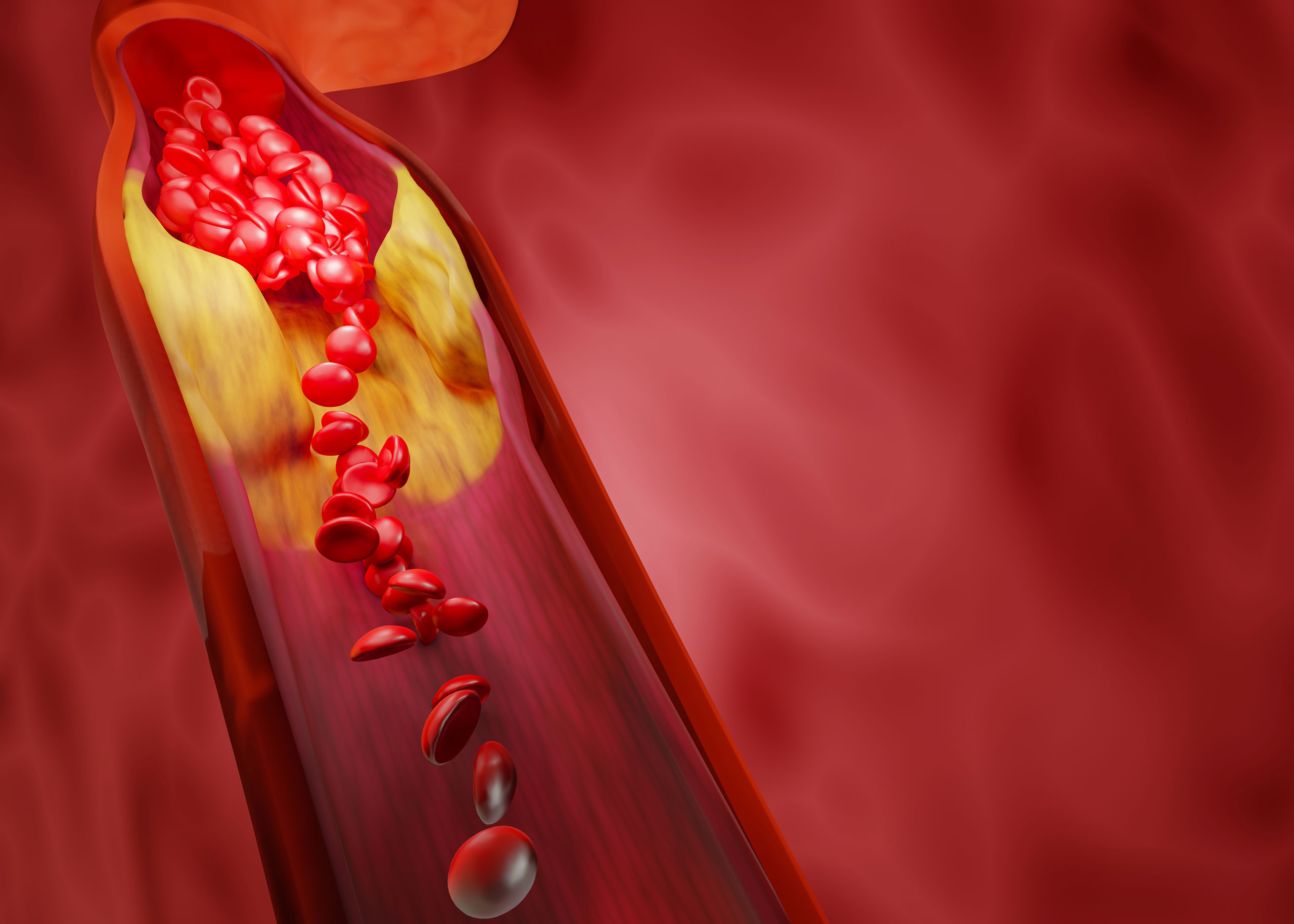 Understanding Hyperlipidemia: Causes, Symptoms, and Treatment Options